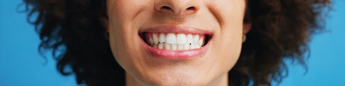 Zahnstein – Ursachen, Behandlung und Vorbeugung Zahnstein – Ursachen, Behandlung und Vorbeugung