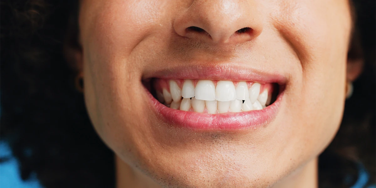 Zahnstein – Ursachen, Behandlung und Vorbeugung